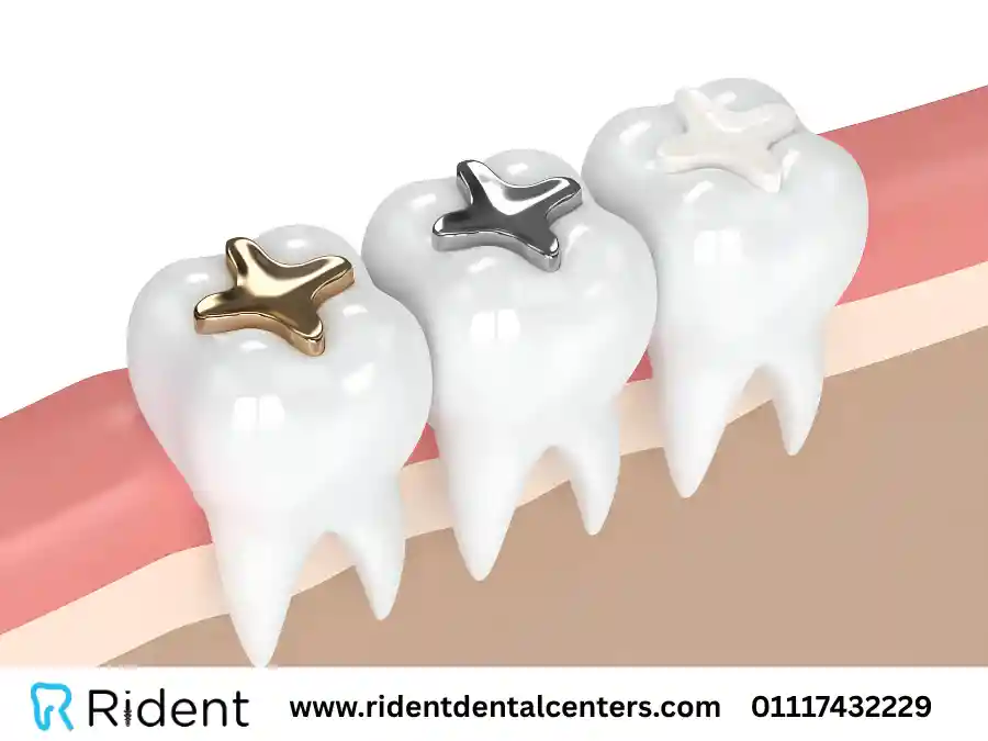 انواع حشو الاسنان